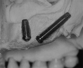 implante dental pterigoideo